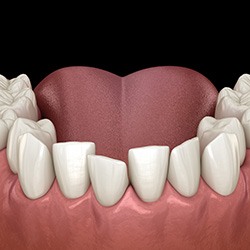 Illustration of crowded teeth in lower arch