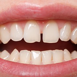 Close-up of smile with gap between upper front teeth