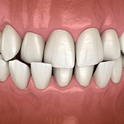 Front view of teeth with cross bite