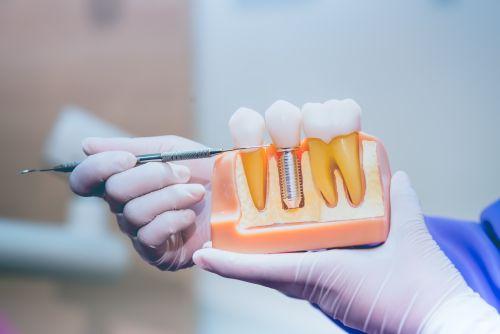 dental implant in lower jaw mold | dental implants cary nc